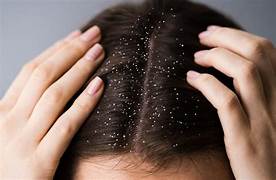 Home Remedies For Dandruff