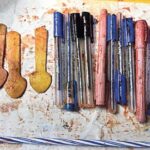 33 Year Old Woman Stomach Yields Pens Wooden Spoons and Candle